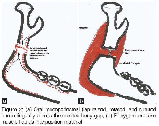 annals-medical-health-sciences-Oral-mucoperiosteal