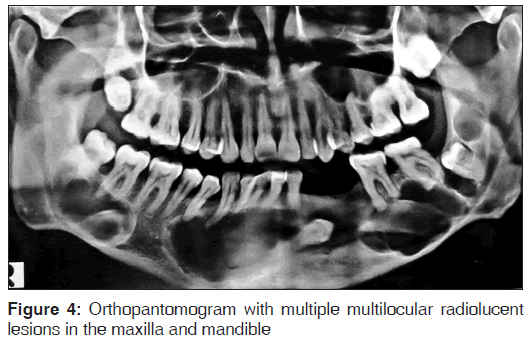 annals-medical-health-sciences-Orthopantomogram