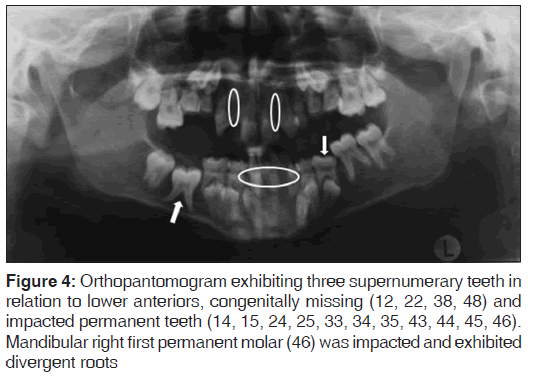 annals-medical-health-sciences-Orthopantomogram