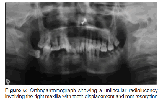 annals-medical-health-sciences-Orthopantomograph-unilocular-radiolucency