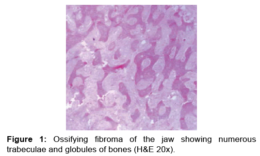 annals-medical-health-sciences-Ossifying-fibroma