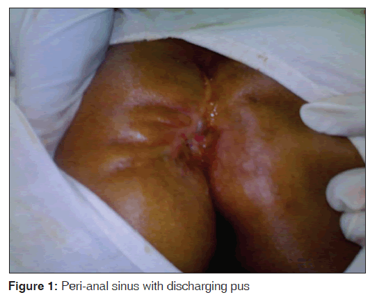 annals-medical-health-sciences-Peri-anal-sinus-discharging-pus