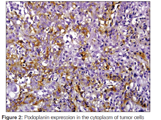 annals-medical-health-sciences-Podoplanin-expression