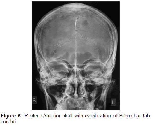 annals-medical-health-sciences-Postero-Anterior