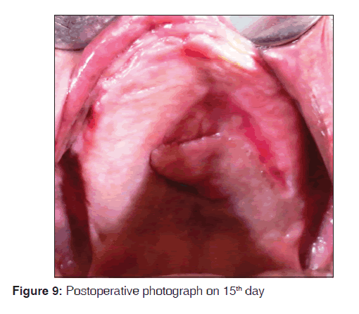 annals-medical-health-sciences-Postoperative