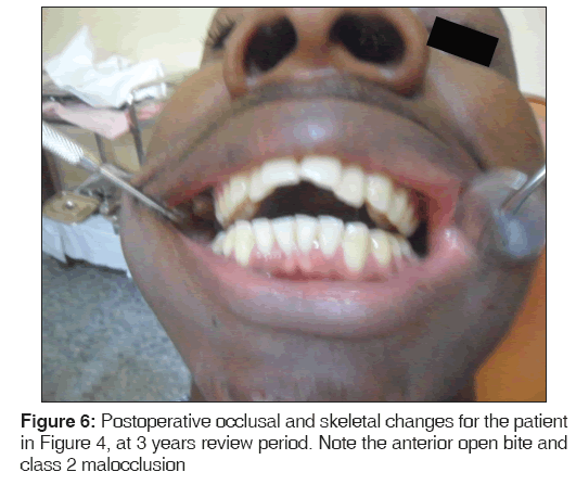 annals-medical-health-sciences-Postoperative-occlusal