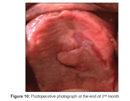 annals-medical-health-sciences-Postoperative-photograph