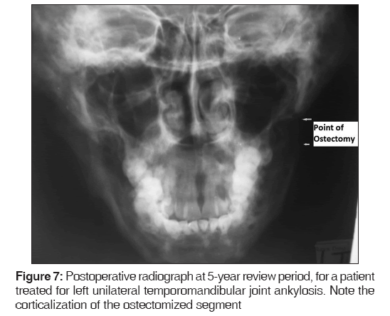 annals-medical-health-sciences-Postoperative-radiograph