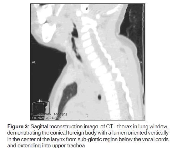 annals-medical-health-sciences-Sagittal-reconstruction-image-CT-thorax