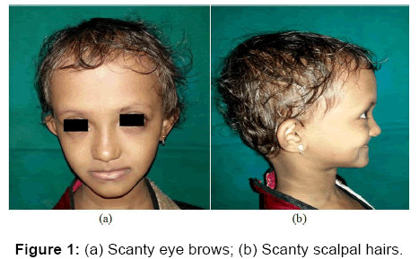 annals-medical-health-sciences-Scanty-eye