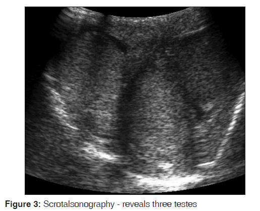 annals-medical-health-sciences-Scrotalsonography-reveals-three-testes