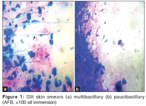 annals-medical-health-sciences-Slit-skin-smears-multibacillary