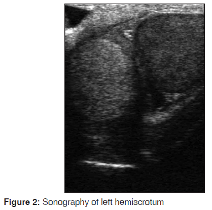 annals-medical-health-sciences-Sonography-left-hemiscrotum