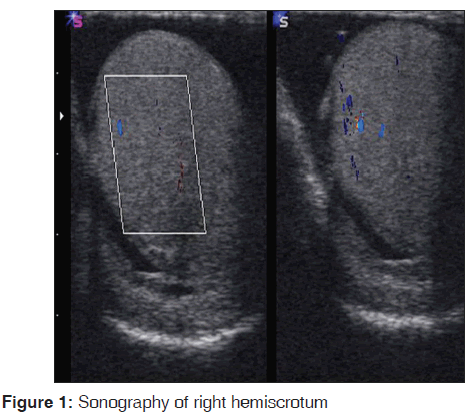 annals-medical-health-sciences-Sonography-right-hemiscrotum