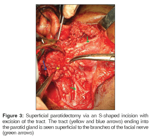 annals-medical-health-sciences-Superficial-parotidectomy