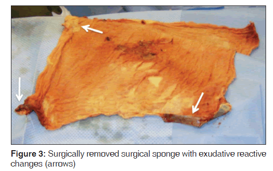 annals-medical-health-sciences-Surgically-removed-surgical-sponge