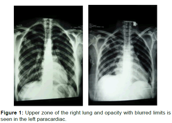 annals-medical-health-sciences-Upper-zone