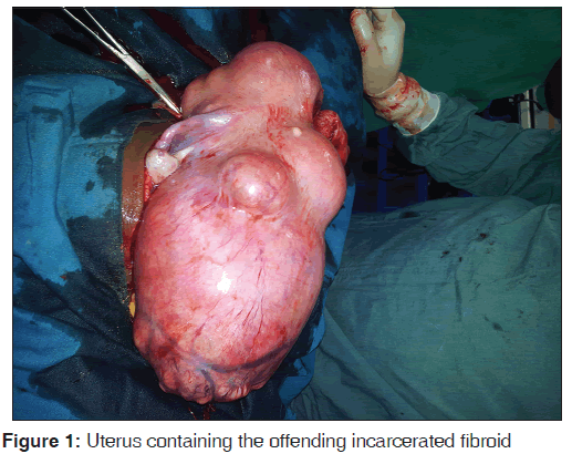 annals-medical-health-sciences-Uterus-containing