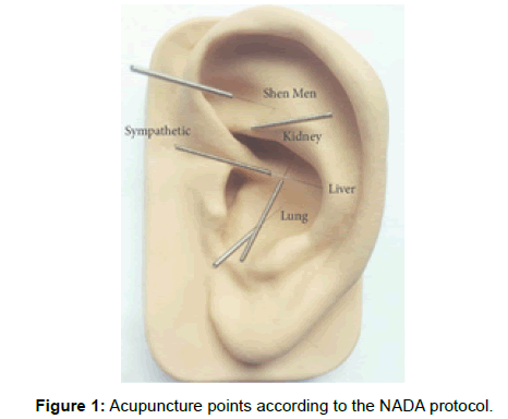 annals-medical-health-sciences-acupuncture