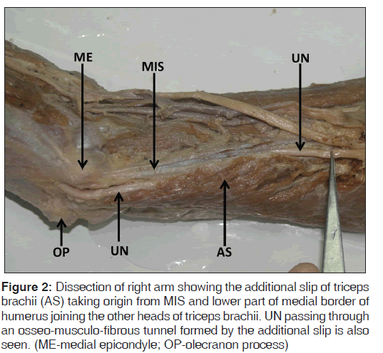 annals-medical-health-sciences-additional-slip-triceps-brachii