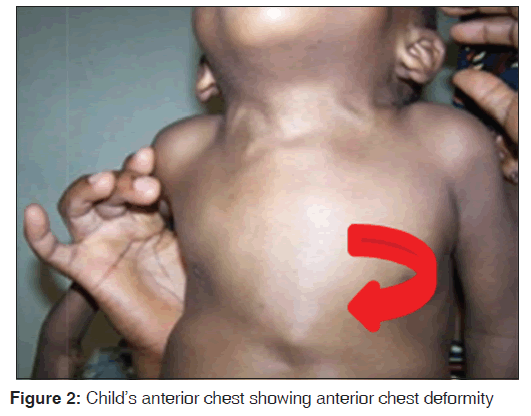 annals-medical-health-sciences-anterior-chest-showing-anterior-chest-deformity
