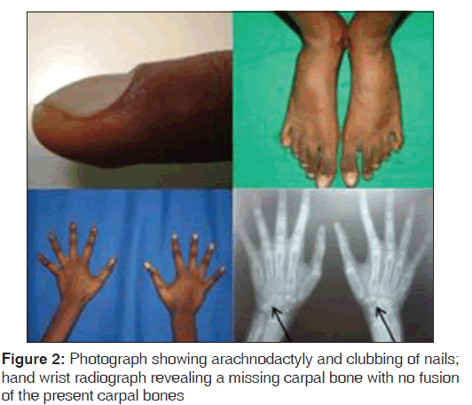 annals-medical-health-sciences-arachnodactyly