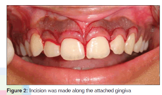 annals-medical-health-sciences-attached-gingiva