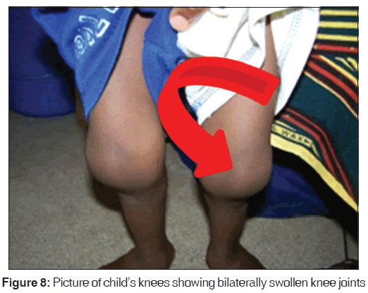 annals-medical-health-sciences-bilaterally-swollen-knee-joints