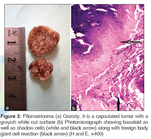 annals-medical-health-sciences-capsulated-tumor