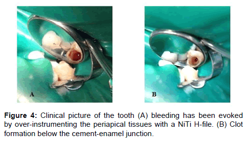 annals-medical-health-sciences-cement-enamel