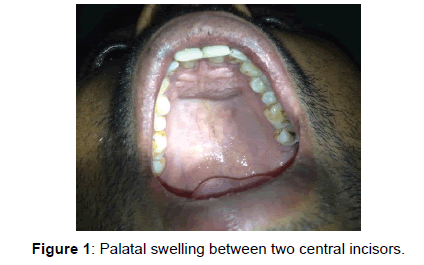 annals-medical-health-sciences-central-incisors