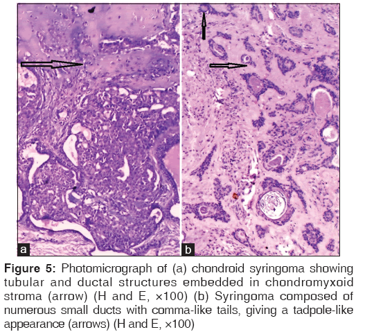 annals-medical-health-sciences-chondroid-syringoma