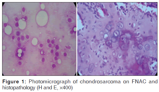 annals-medical-health-sciences-chondrosarcoma