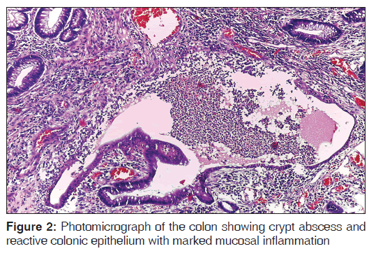 annals-medical-health-sciences-crypt-abscess