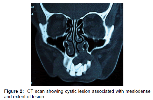 annals-medical-health-sciences-cystic-lesion