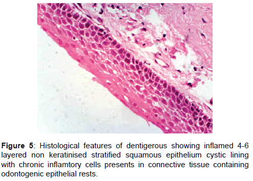 annals-medical-health-sciences-dentigerous