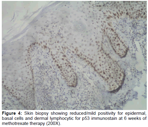 annals-medical-health-sciences-dermal-lymphocytic