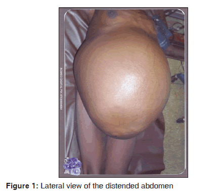 annals-medical-health-sciences-distended-abdomen