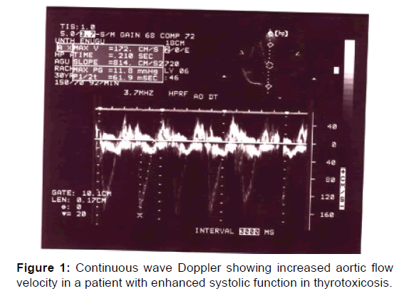 annals-medical-health-sciences-doppler