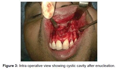 annals-medical-health-sciences-enucleation