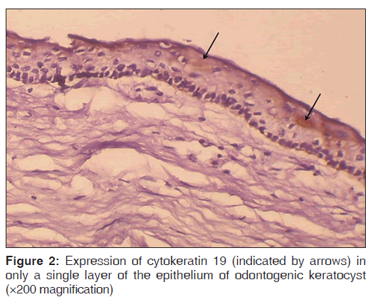 annals-medical-health-sciences-epithelium-odontogenic