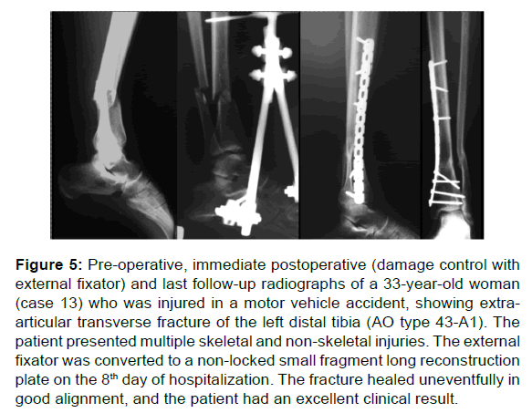 annals-medical-health-sciences-external-fixator