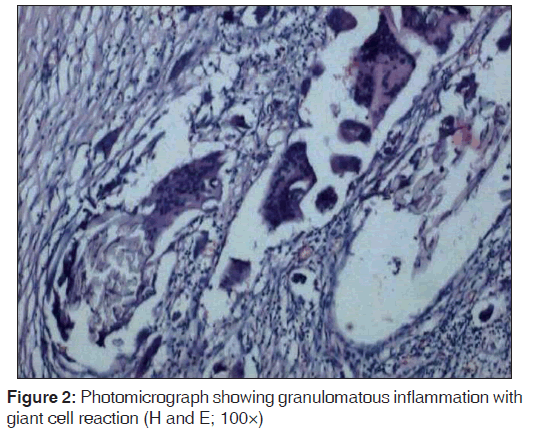 annals-medical-health-sciences-granulomatou-inflammation-giant-cell-reaction