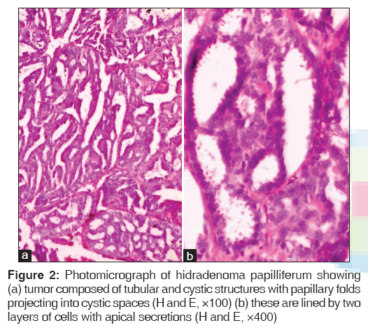 annals-medical-health-sciences-hidradenoma-papilliferum