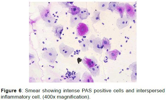 annals-medical-health-sciences-inflammatory-cell