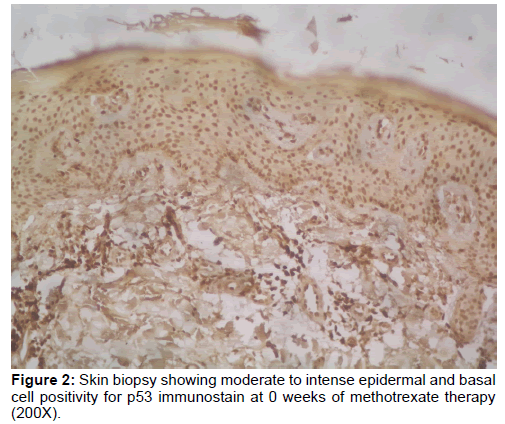 annals-medical-health-sciences-intense-epidermal