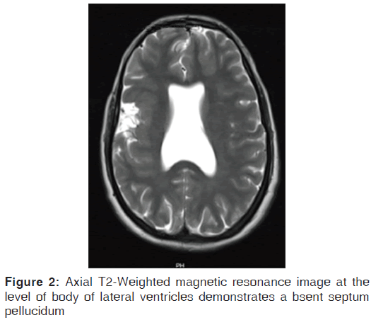 annals-medical-health-sciences-lateral-ventricles