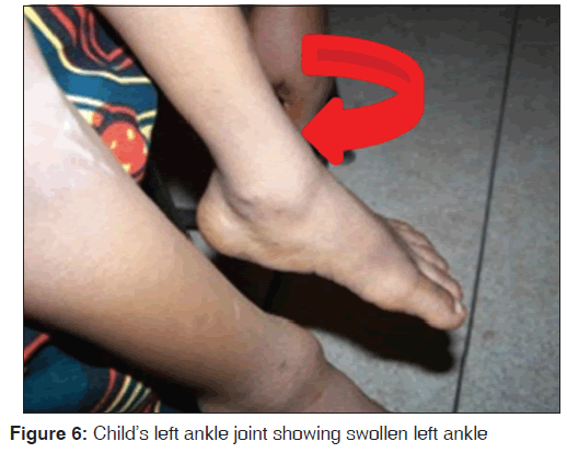 annals-medical-health-sciences-left-ankle-joint-showing-swollen-left-ankle