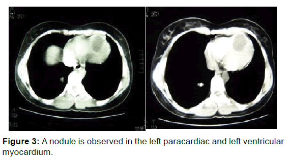 annals-medical-health-sciences-left-paracardiac