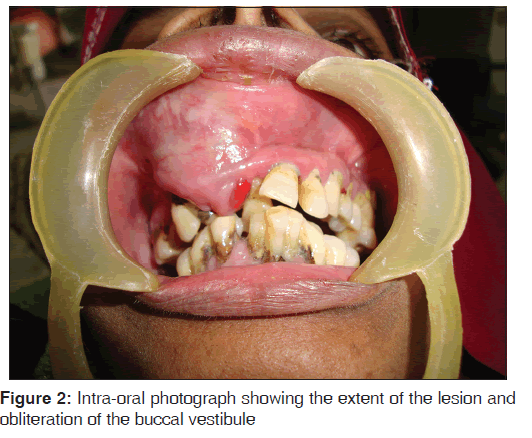 annals-medical-health-sciences-lesion-obliteration-buccal-vestibule